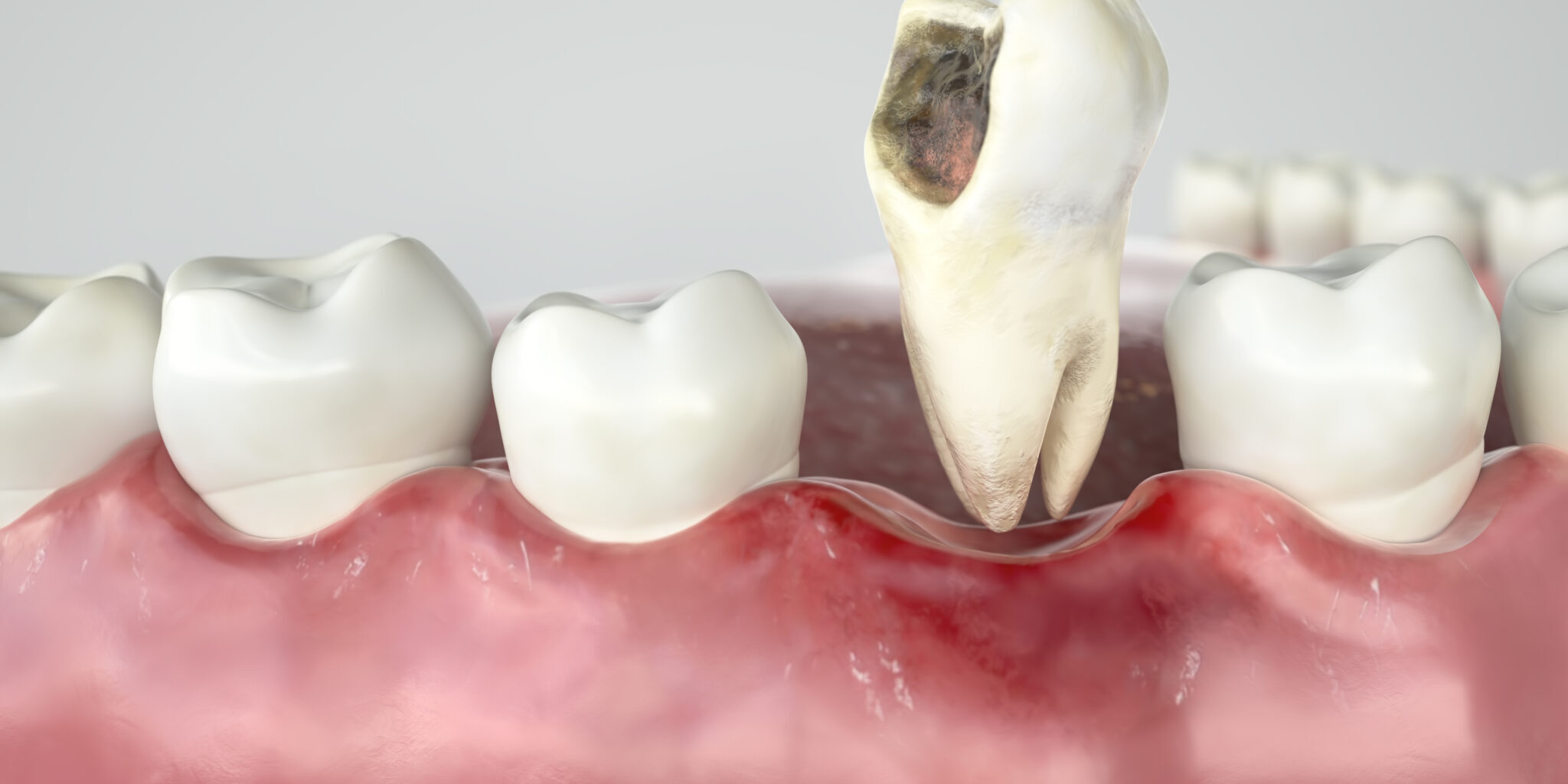 Sign You Need A Dental Extraction In Abbeville Dr Lance Savoie Dental